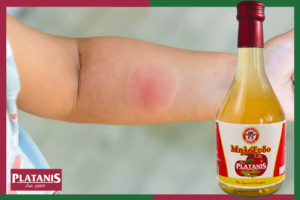 A nasty mosquito bite on a toddler's arm with a bottle of Platanis Apple Cider Vinegar ready to be used for mosquito bite relief